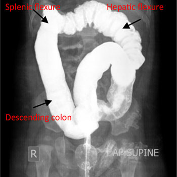 Situs Inversus with Dextrocardia