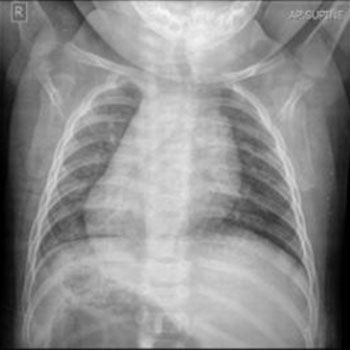 Situs Inversus with Dextrocardia