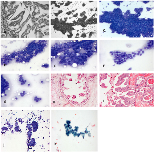 intraductalis papilloma c3