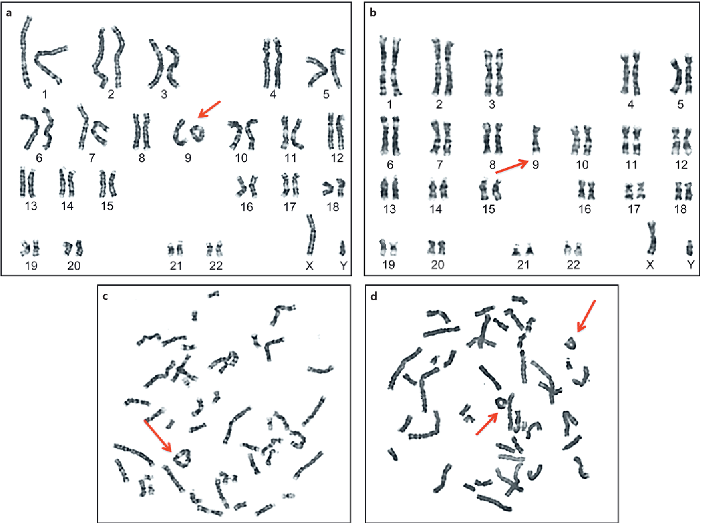 SciELO - Brasil - Epilepsy and ring chromosome 20: case report Epilepsy and ring  chromosome 20: case report