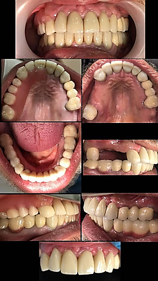 Oral Rehabilitation Case enhanced by Plastic Periodontal Surgery using ...