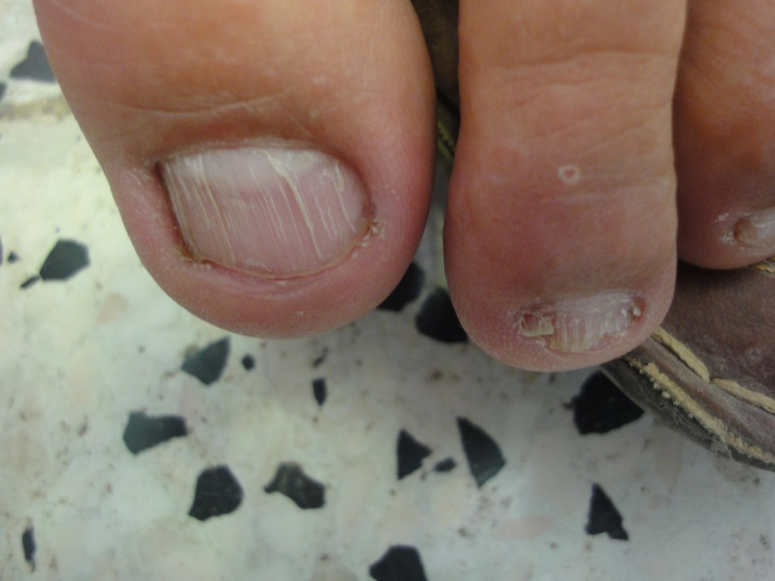 Treatment of pincer nail deformity with 1064‐nm Nd:YAG laser - Daye - 2021  - Journal of Cosmetic Dermatology - Wiley Online Library