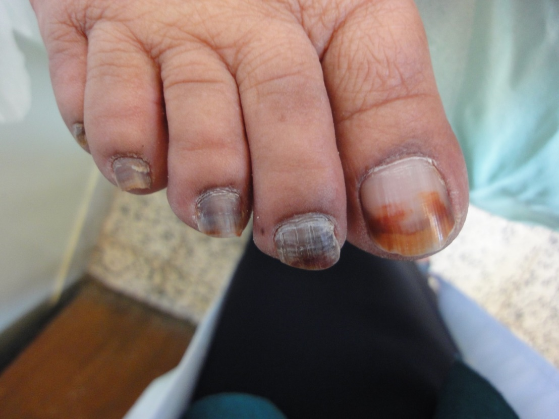 An Atlas of Nail Disorders, Part 1 | Consultant360