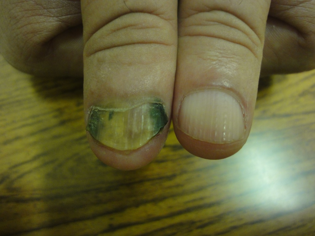 Chloronychia - NailKnowledge