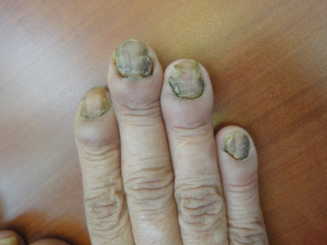 Green Nail Syndrome (Pseudomonas aeruginosa Nail Infection): Two Cases  Successfully Treated with Topical Nadifloxacin, an Acne Medication. -  Abstract - Europe PMC