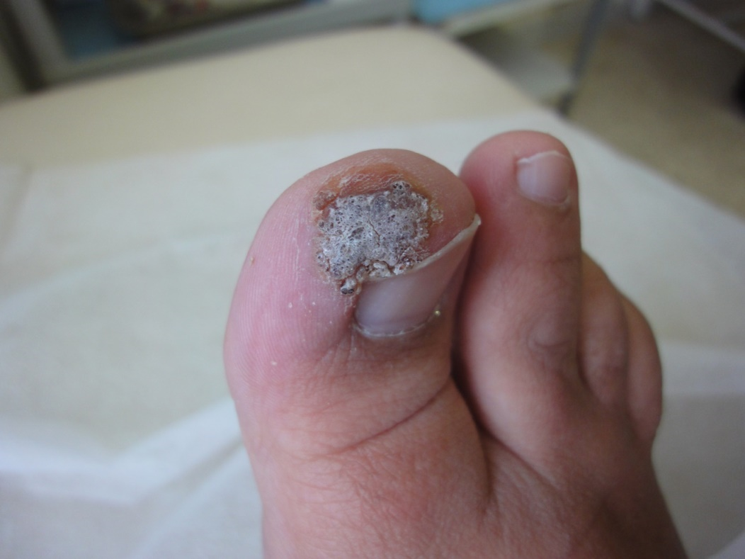Dermoscopic Features of Green Nail Syndrome Associated with Dermatophytosis  and, Traumatic Onycholysis