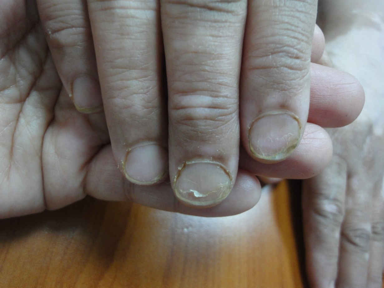 What is the likely cause of the nail dystrophy seen here? | Duke Health  Referring Physicians