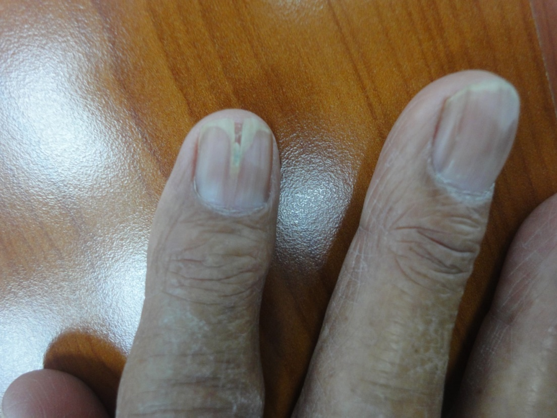 Assessment of clinical and etiological factors in nail dyschromias - IJCED