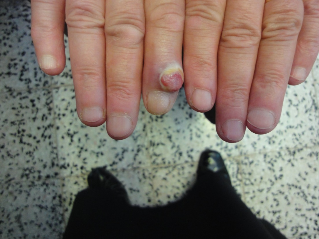 Nail Disorders in Children. - Abstract - Europe PMC