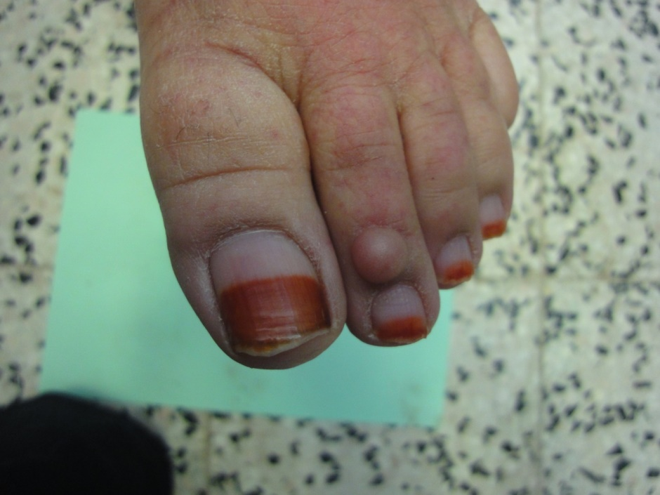 2012.3-2.A study of nail - Our Dermatology Online