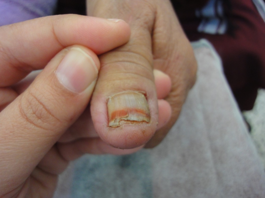 Half and half nail (Lindasy's nail) and Terry's nail || Brown nail  pigmentation || Nail in CKD - YouTube