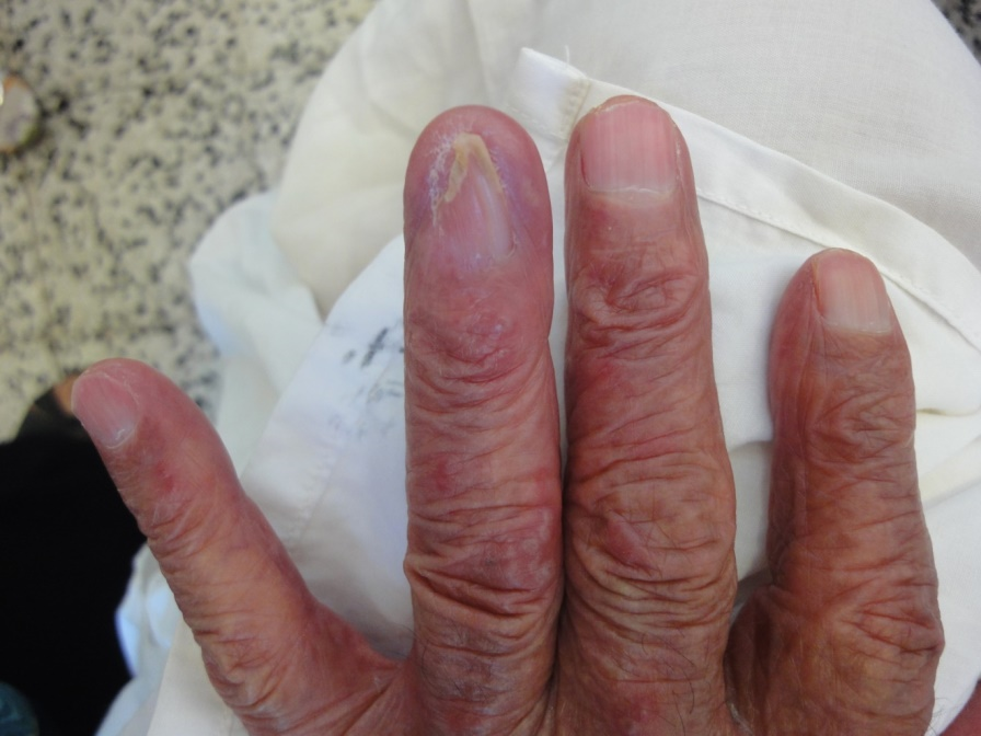 PDF) Nail Involvement in Pemphigus Vulgaris