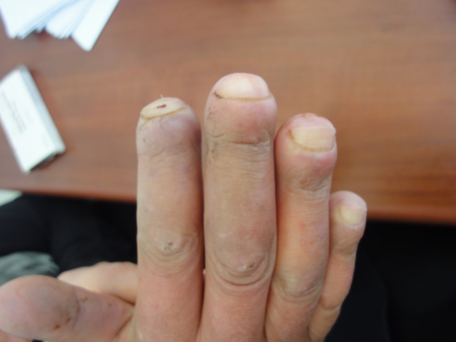 How to trim thickened toenails - Mayo Clinic