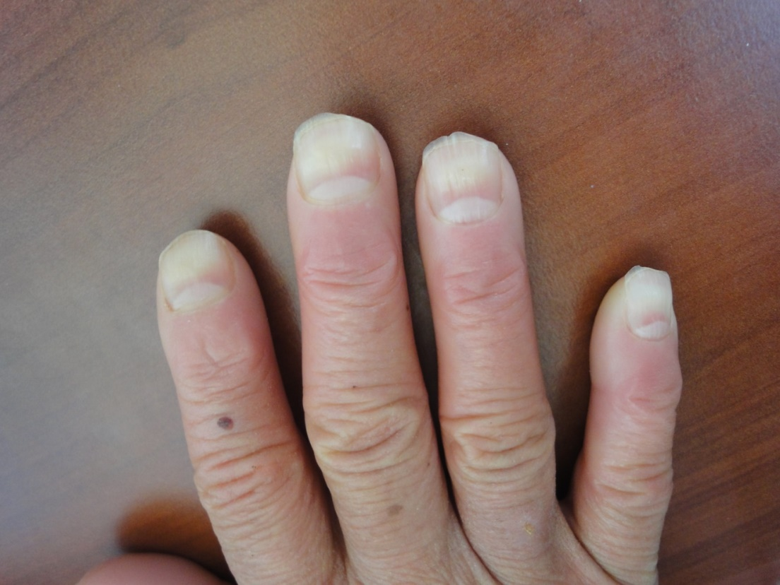 7 Gross Things That Happen When You Bite Your Nails | Prevention