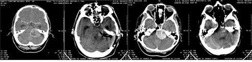 Endoscopic Keyhole and Microsurgery Approach to Cerebellopontine angle ...