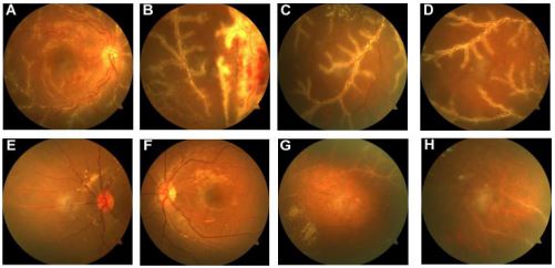 cmv retinitis